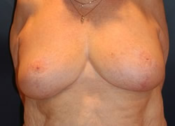 Breast Reduction Patient 28581 Photo 2