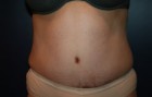 Tummy Tuck Patient 10126 Photo 2