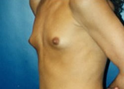 Breast Augmentation Patient 33756 Photo 3