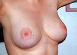 Breast Reduction Patient 14293 Photo 2