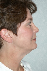 Facelift Patient 30275 Photo 2