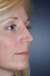 Rhinoplasty Patient 24779 Photo 1