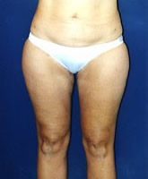 Liposculpture/Liposuction Patient 18798 Photo 2