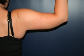Arm Liposuction and Arm Brachioplasty Patient 40639 Photo 2