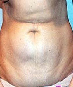 Tummy Tuck Patient 97964 Photo 3