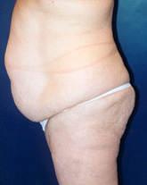 Tummy Tuck Patient 31720 Photo 3