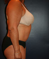 Tummy Tuck Patient 56322 Photo 4