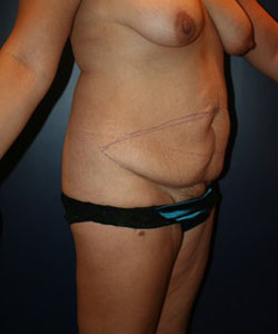 Tummy Tuck Patient 16803 Photo 1