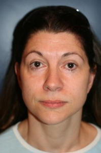 Laser Skin Resurfacing Patient 30189 Photo 2