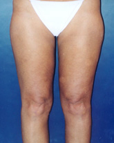 Liposculpture/Liposuction Patient 73218 Photo 4