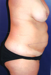 Tummy Tuck Patient 98082 Photo 3