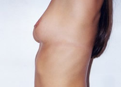 Breast Augmentation Patient 41941 Photo 3