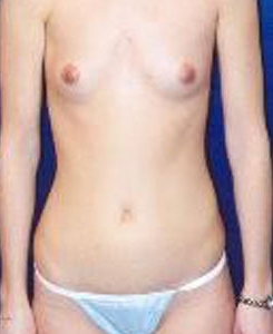 Breast Augmentation Patient 94607 Photo 1